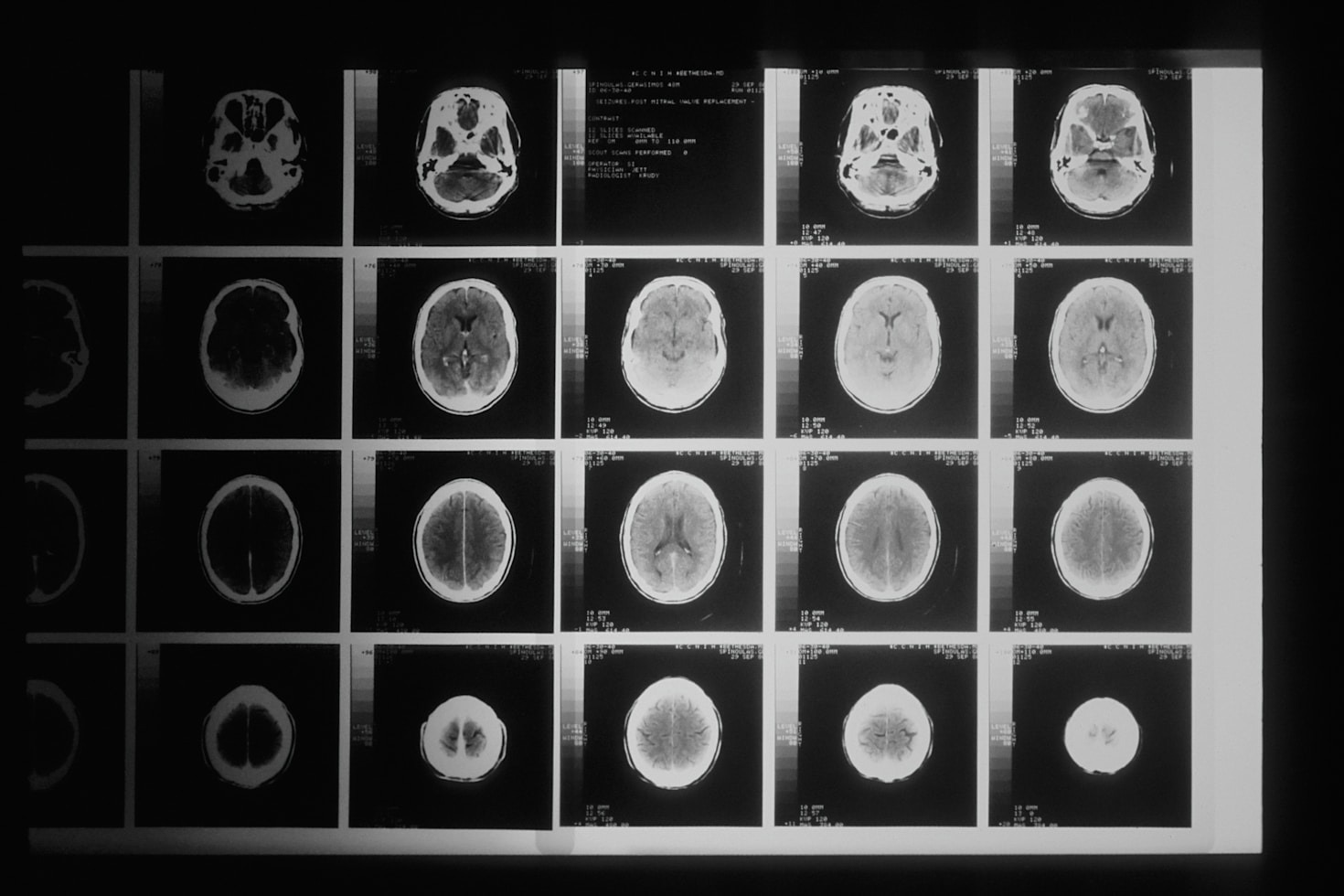 Coping Strategies for Families of Brain Tumor Patients
